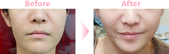 Mwデュアルリフトによるリフトアップ 小顔治療 東京 池袋サンシャイン美容外科