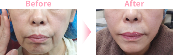 Mwデュアルリフトによるリフトアップ 小顔治療 東京 池袋サンシャイン美容外科